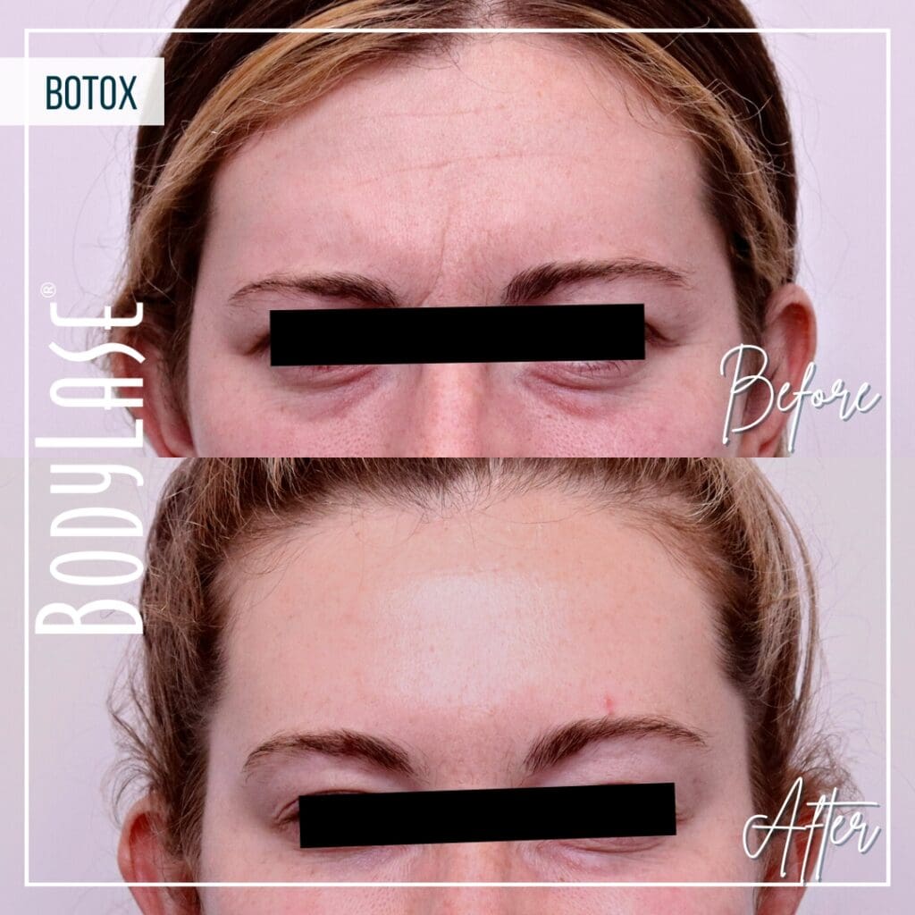 Botox Before and After