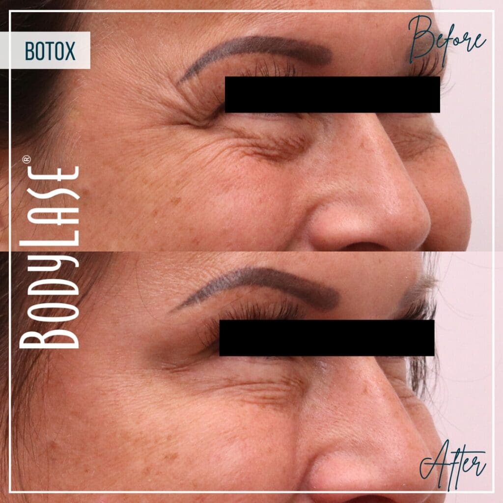 Botox Before and After