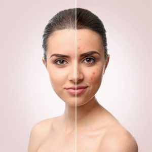 Model Getting Rid of Acne Scars