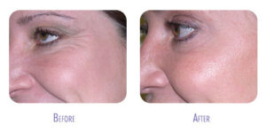 Before and after botox cosmetic treatment results