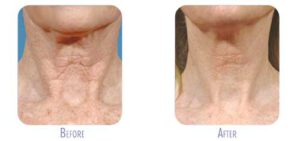 Before and after fraxel® results | bodylase®