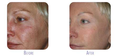 Before and after Fraxel® facial treatment results