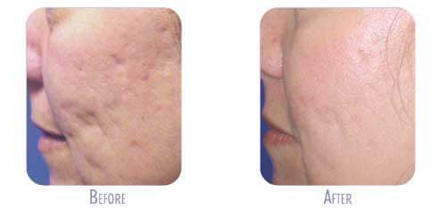 Before and after Fraxel® skin resurfacing results