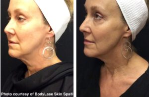 Before and after ultherapy® non invasive treatment results | bodylase®