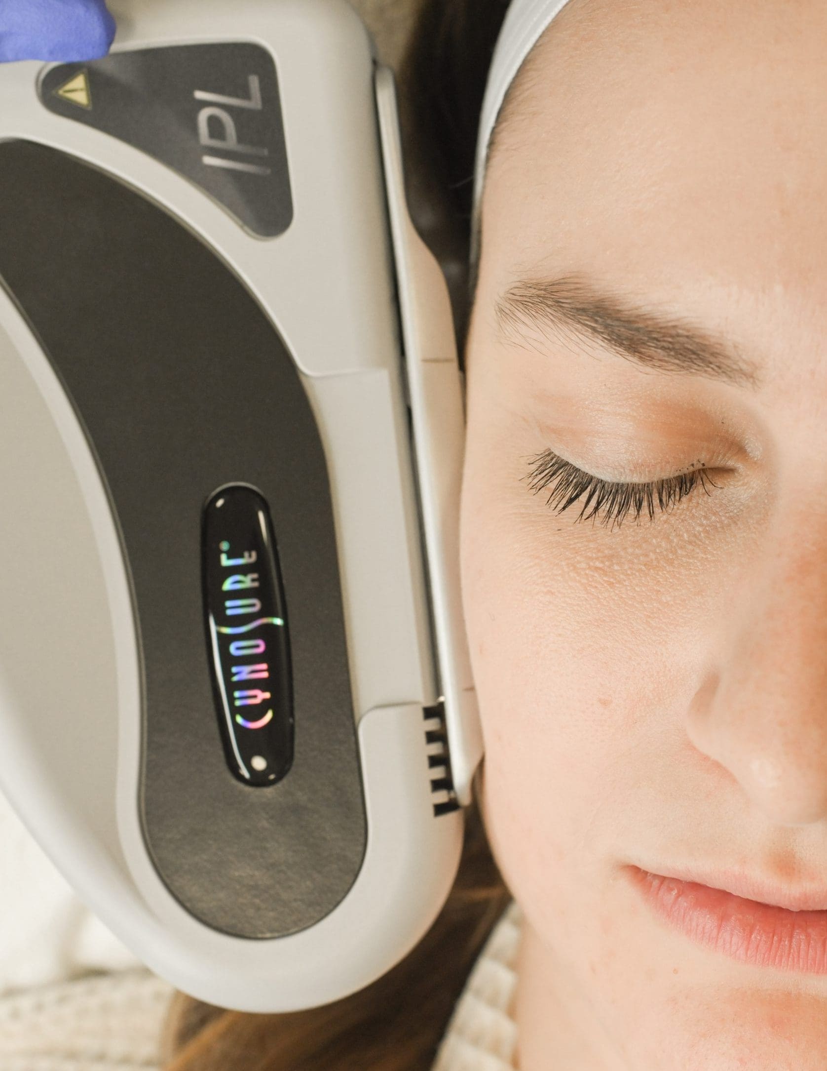 IPL Photofacial BodyLase®