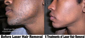 Before and after laser hair removal results | bodylase®