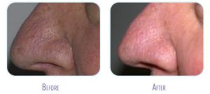 Before and after laser vein therapy