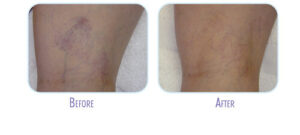 Before and after laser vein therapy | bodylase®