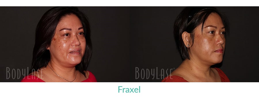 Before and after Fraxel treatment results