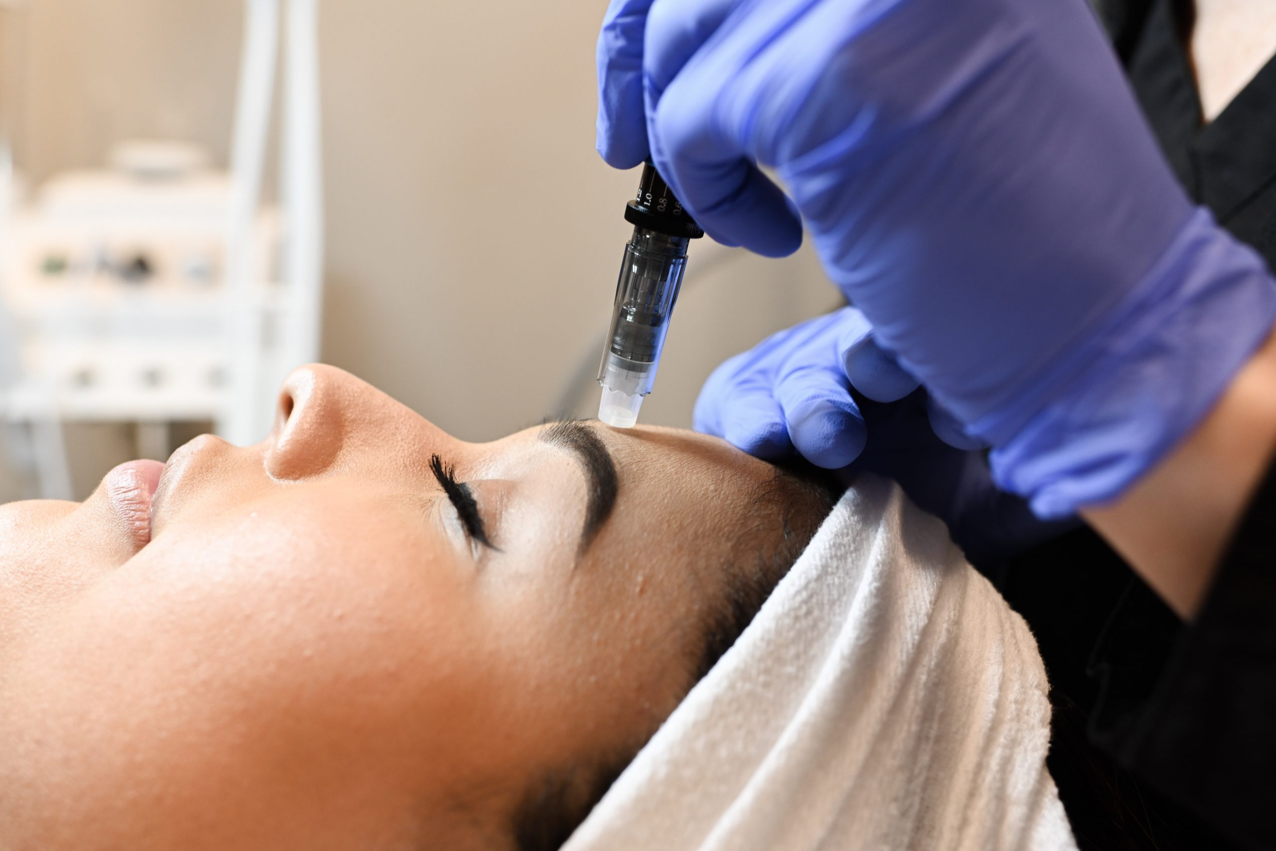 Microneedling treatment at BodyLase
