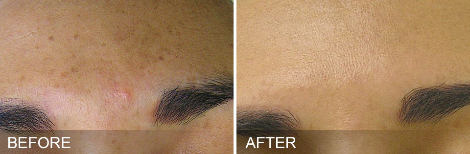 Before and after HydraFacial® results