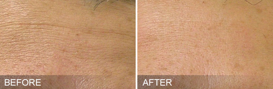 Before and after HydraFacial®treatment results