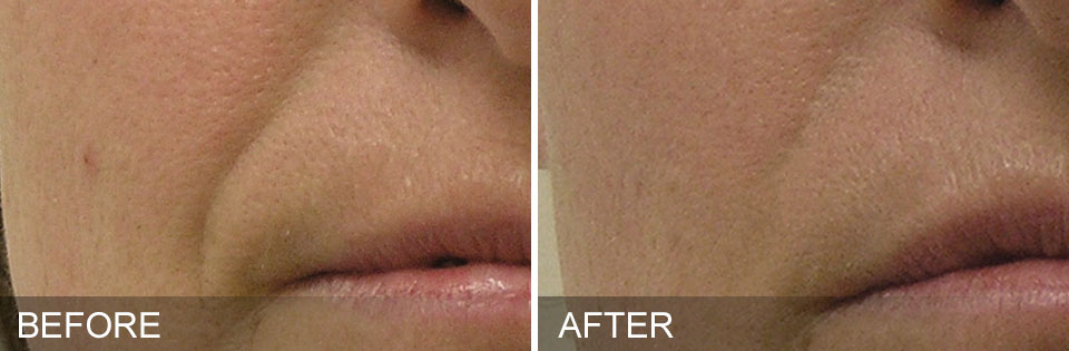 Before and after HydraFacial® skin treatment results