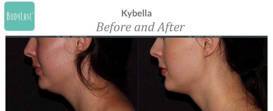 Before and after KYBELLA® treatment results