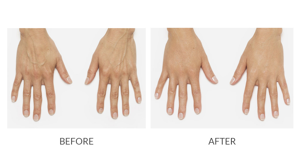 Before and after RADIESSE® treatment results