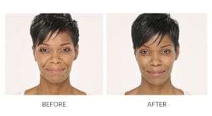 RADIESSE® treatment before and after results
