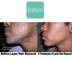 Before and after laser hair removal treatment results