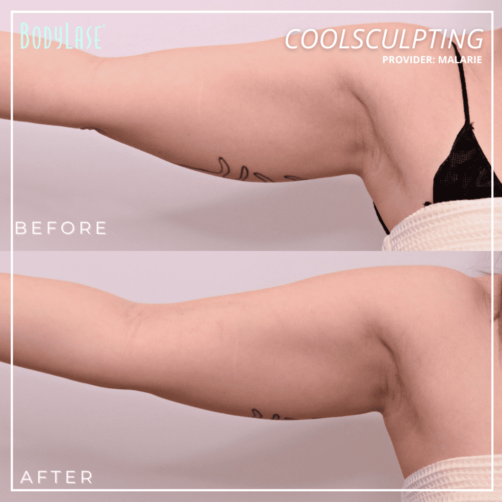 What is Coolsculpting? An In-Depth Guide for 2026 2 Coolsculpting