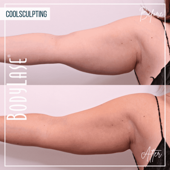Before and After Coolsculpting