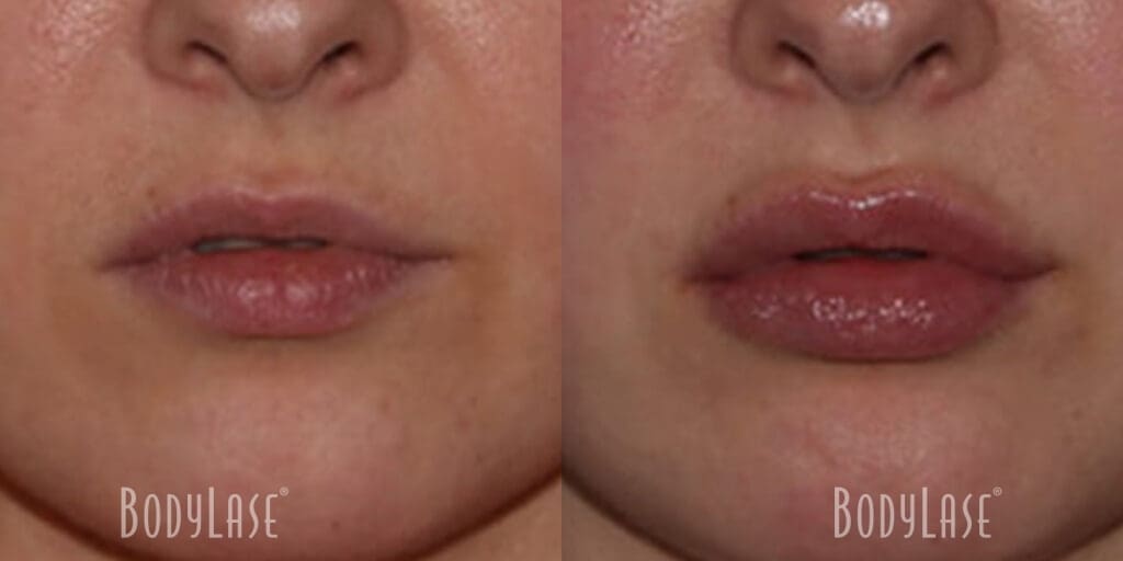 Lip Filler before and after