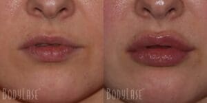 before and after lip filler