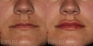 Before and after lip filler