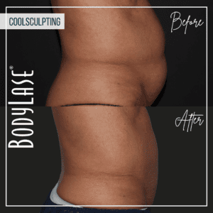 Before and after coolsculpting