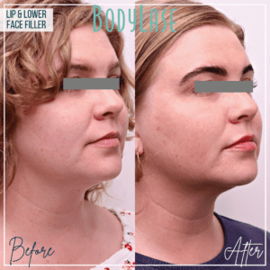 Lip and Lower Face Filler before and after
