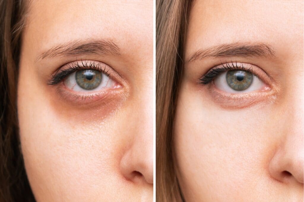 Dark Circles before and after