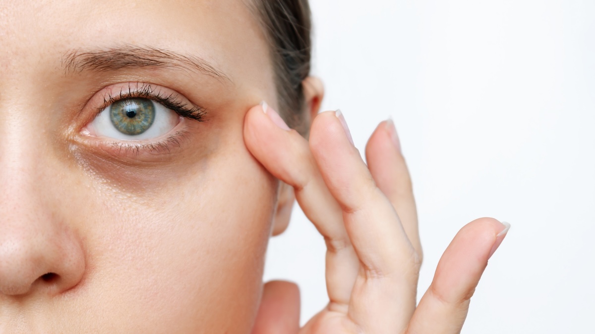 How To Remove Dark Circles Under Eyes