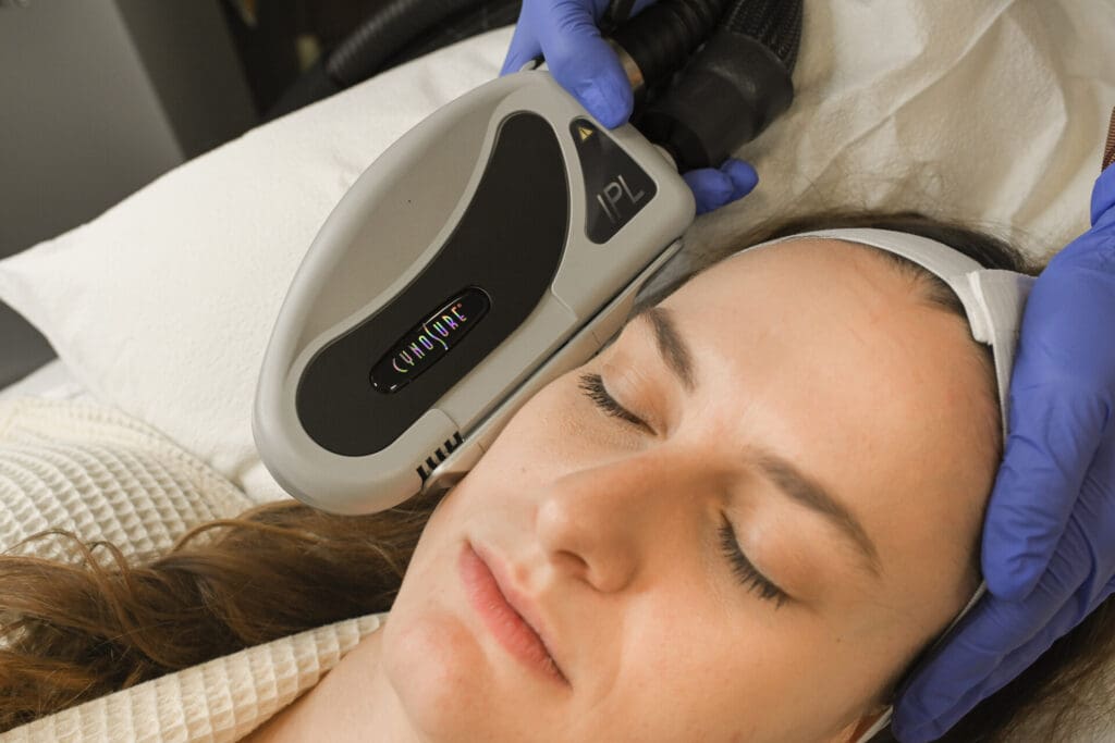 IPL Photofacial