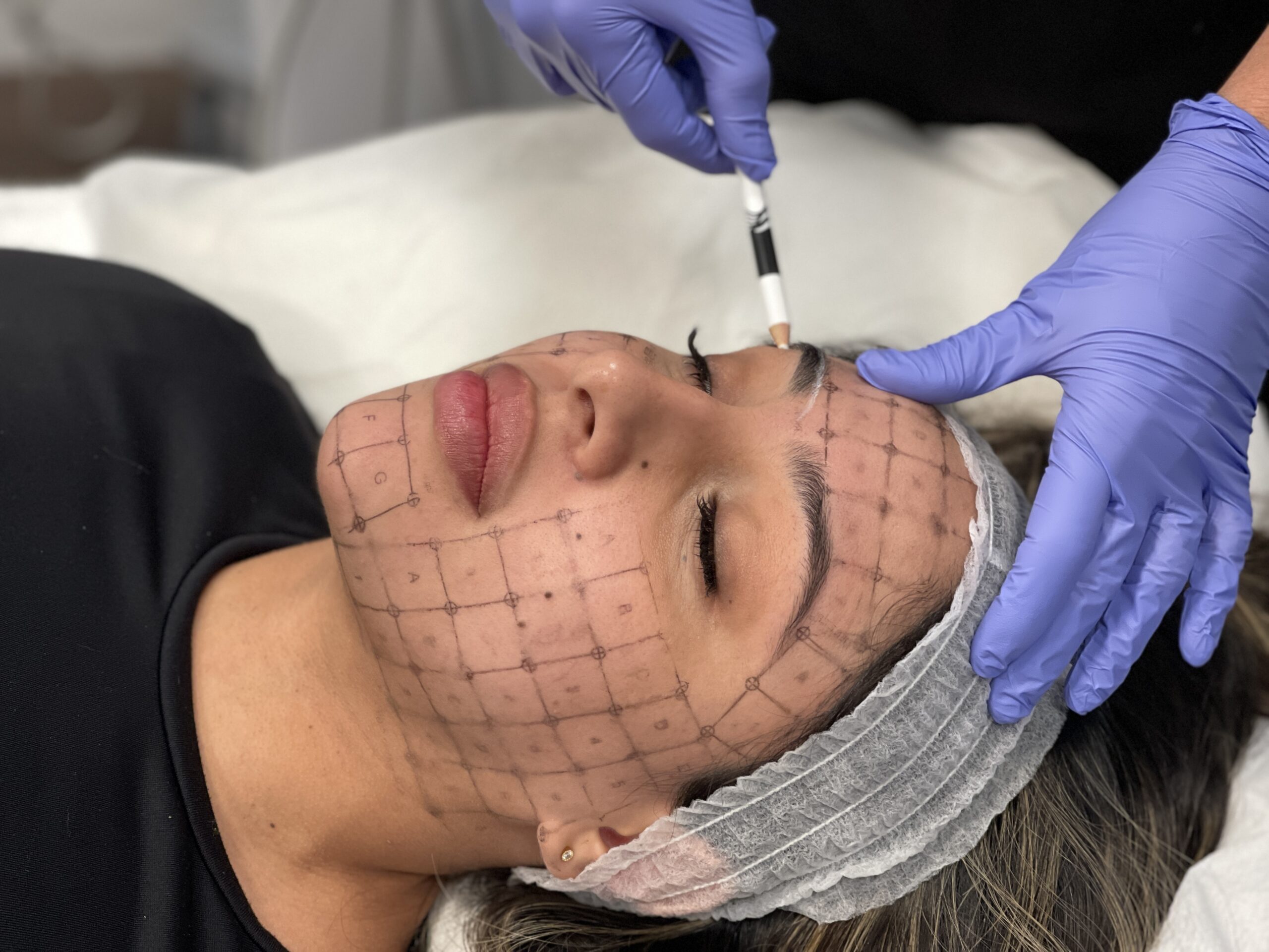 Thermage Treatment