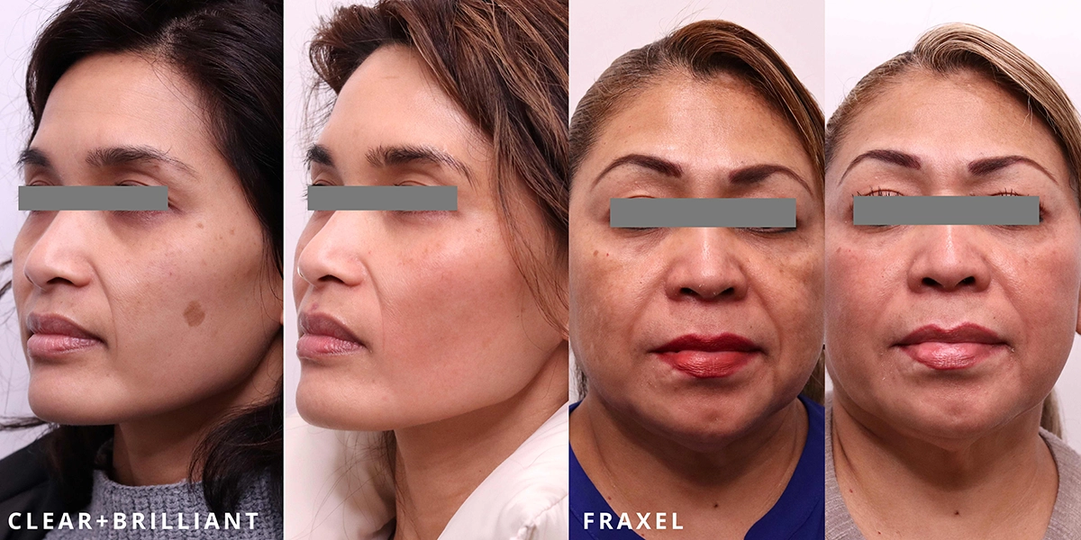 Reverse & Repair B&As Fraxel and Clear+Brilliant