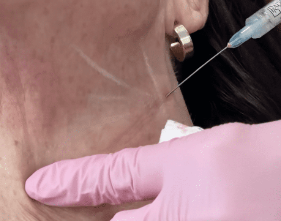 Hyperdiluate Radiesse