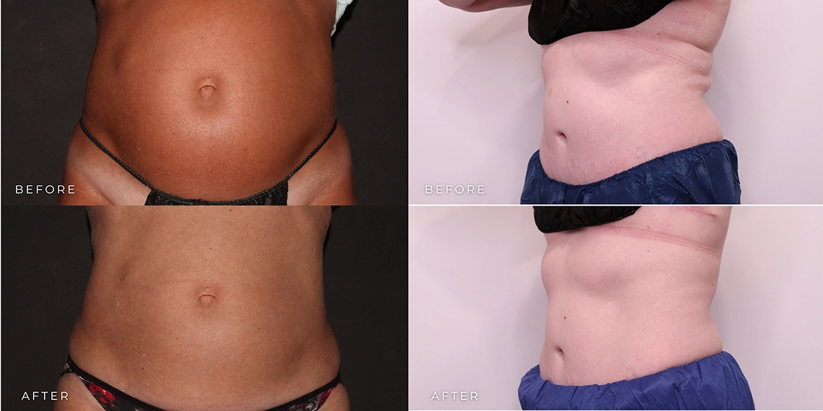 winter wonder body consultation before and after