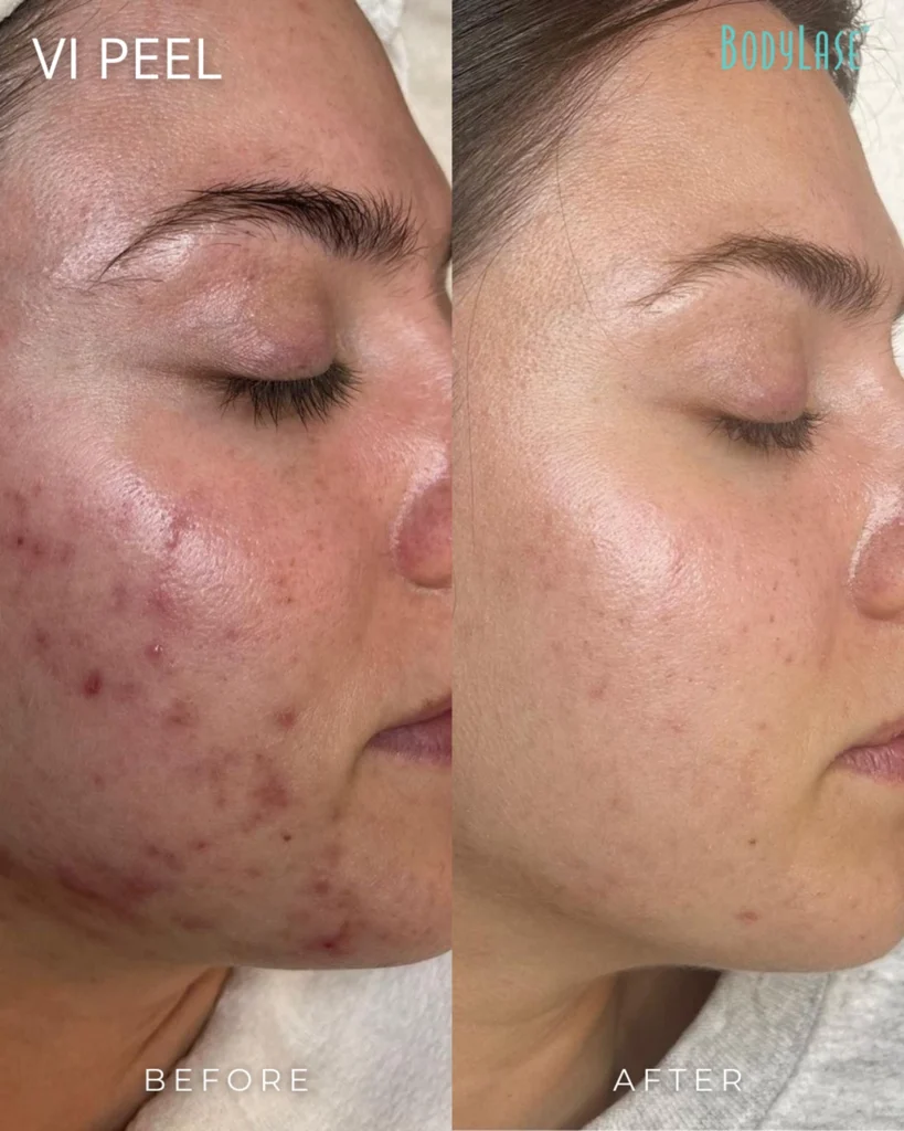 chemical peel before & after