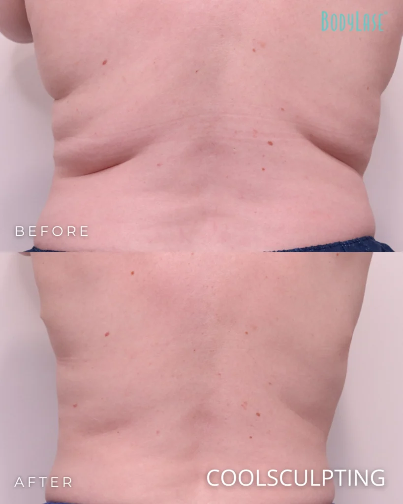 CoolSculpting® Elite in Raleigh, Cary, Chapel Hill, and Clayton, NC 14 coolsculpting before & after
