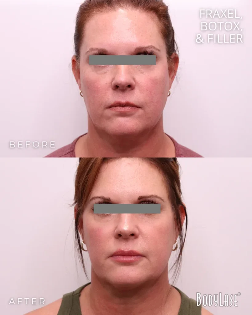 fraxel before & after