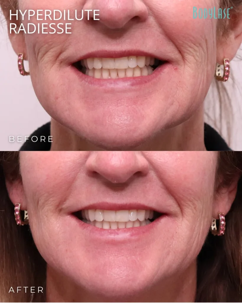 hyperdillute radiesse before & after