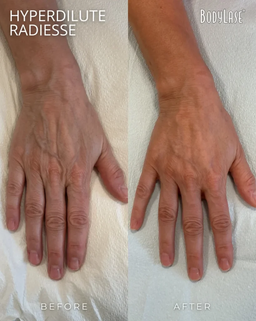 Hyperdilute Radiesse in Raleigh, Cary, Chapel Hill, and Clayton, NC 14 hyperdillute radiesse before & after