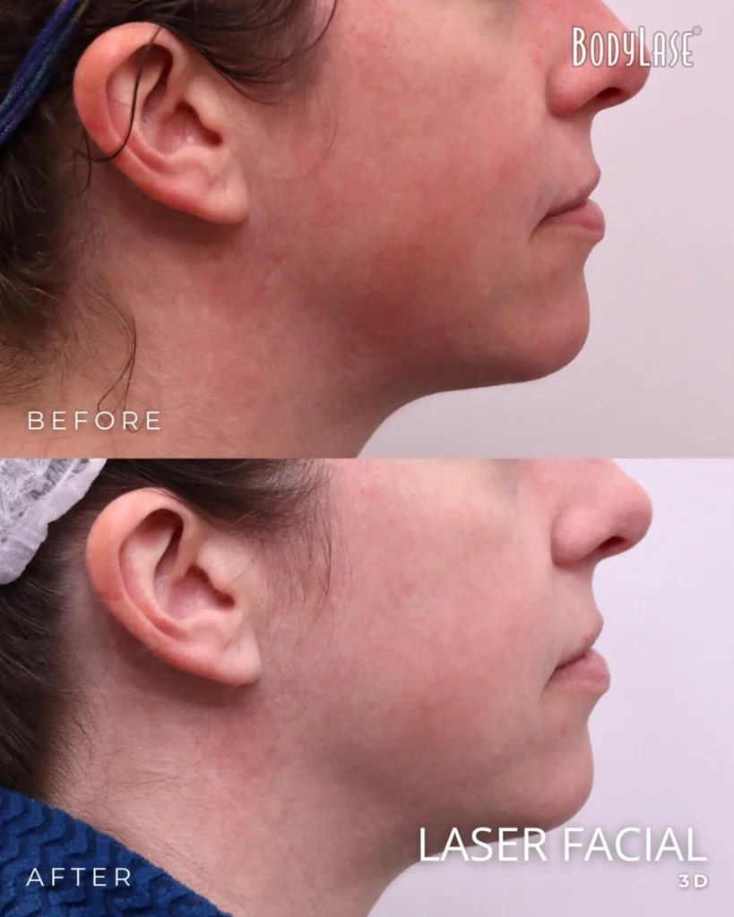 laser facial before & after