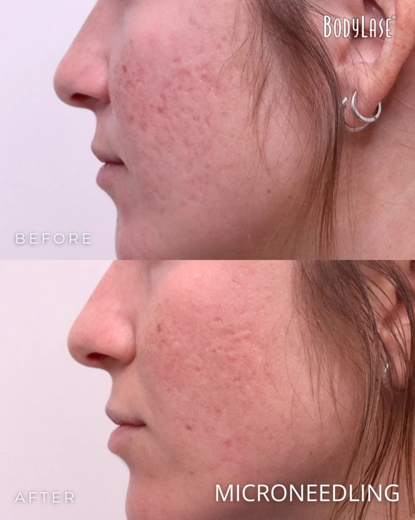 microneedling before & after