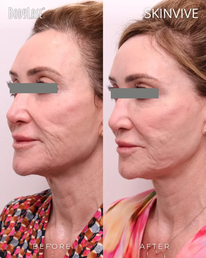 skinvive before & after