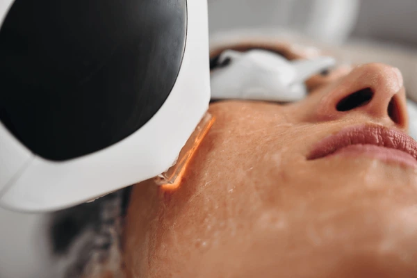 IPL treatment used to improve visible facial capillaries