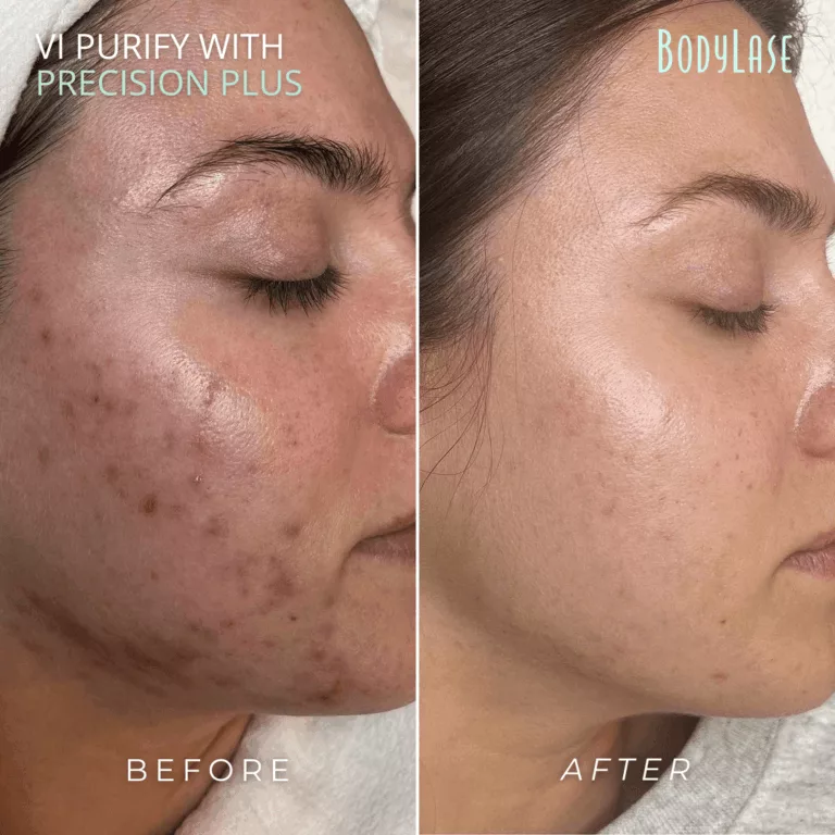 Types of Chemical Peels