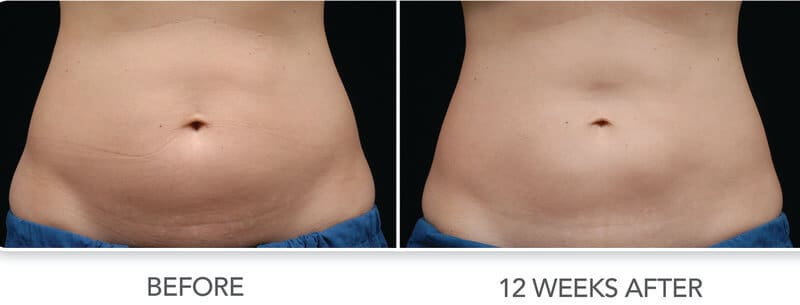 BodyLase® Med Spa - Coolsculpting
