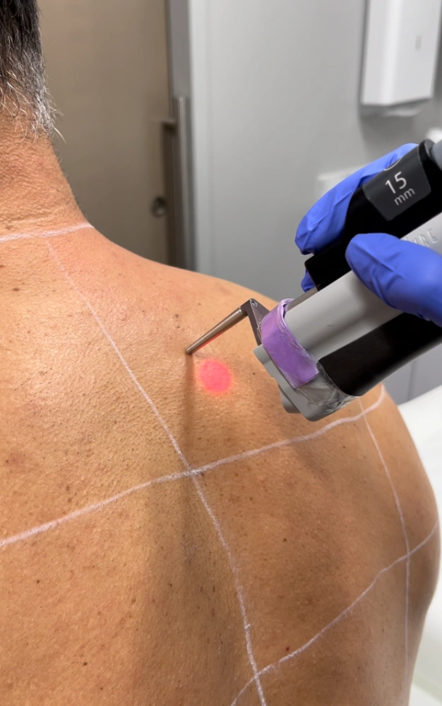 BodyLase® Med Spa - Laser Hair Removal Male back BodyLase
