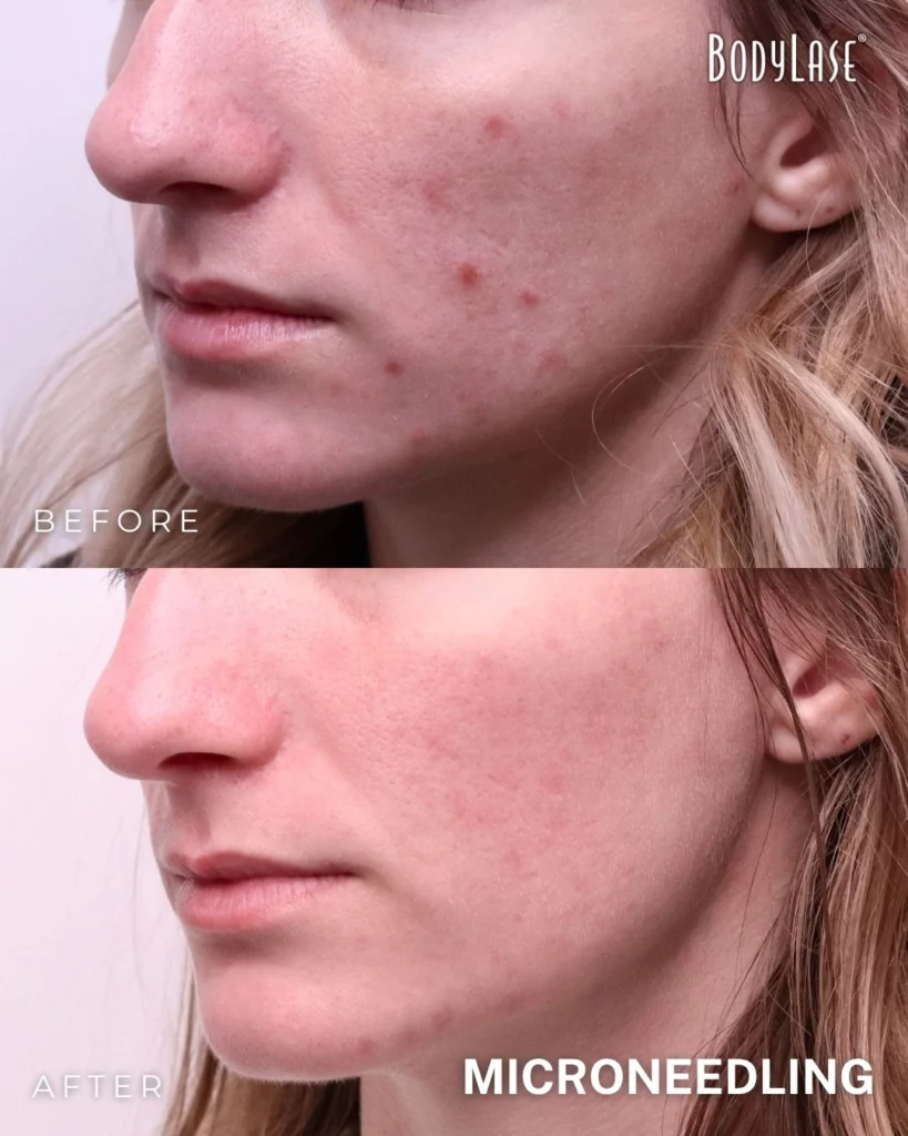 BodyLase® Med Spa - Microneedling 3
