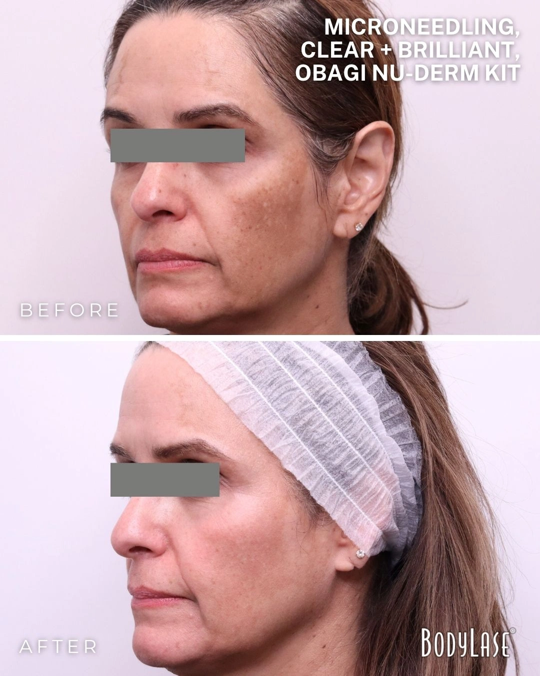 RF microneedling before and after result 1