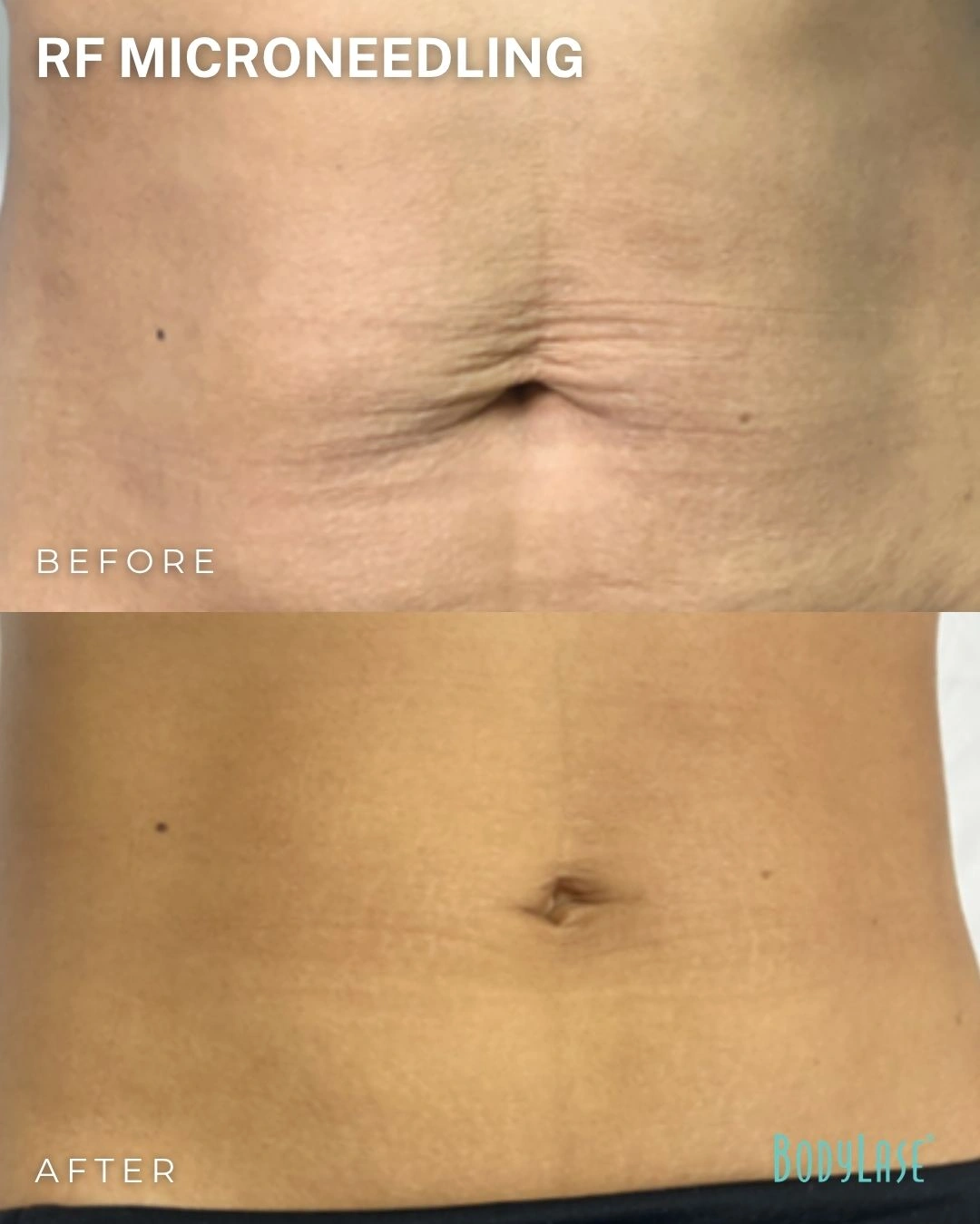 RF microneedling before and after result 3